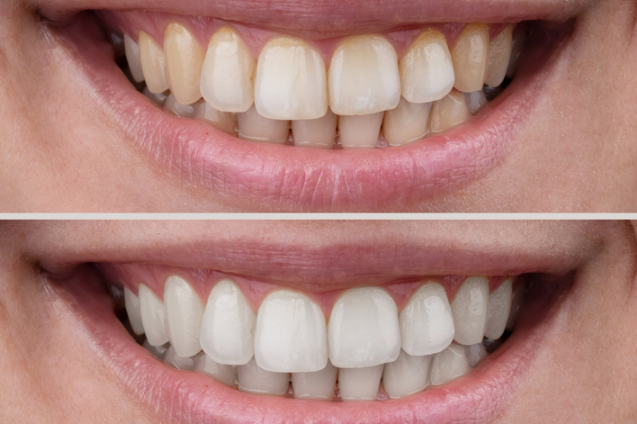 teeth whitening