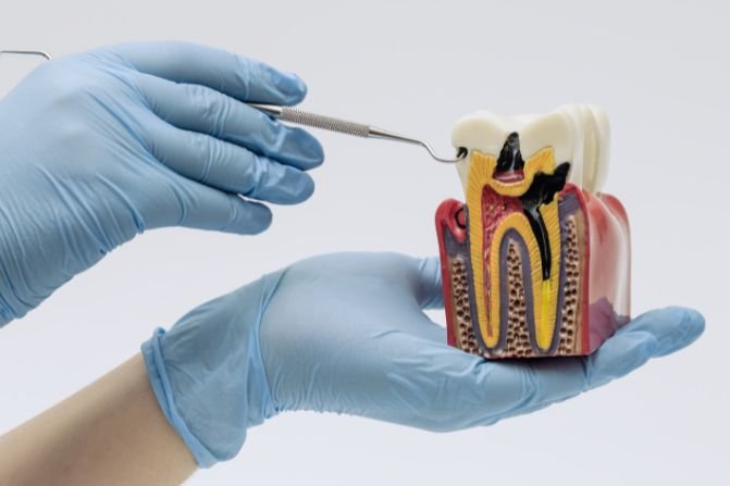root canal treatment image