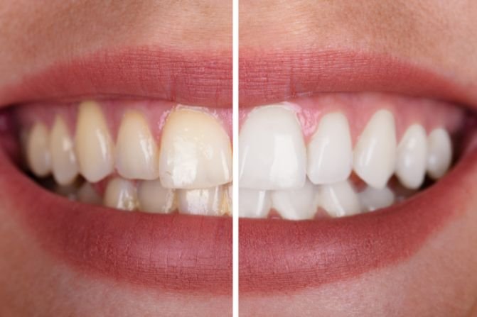 tooth whitening image