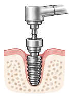 dental-implant-placement-icon.png