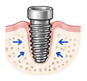 : dental-implant-healing-integration-icon.png