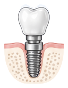 fitting-dental-implant-replacement-teeth-icon.png