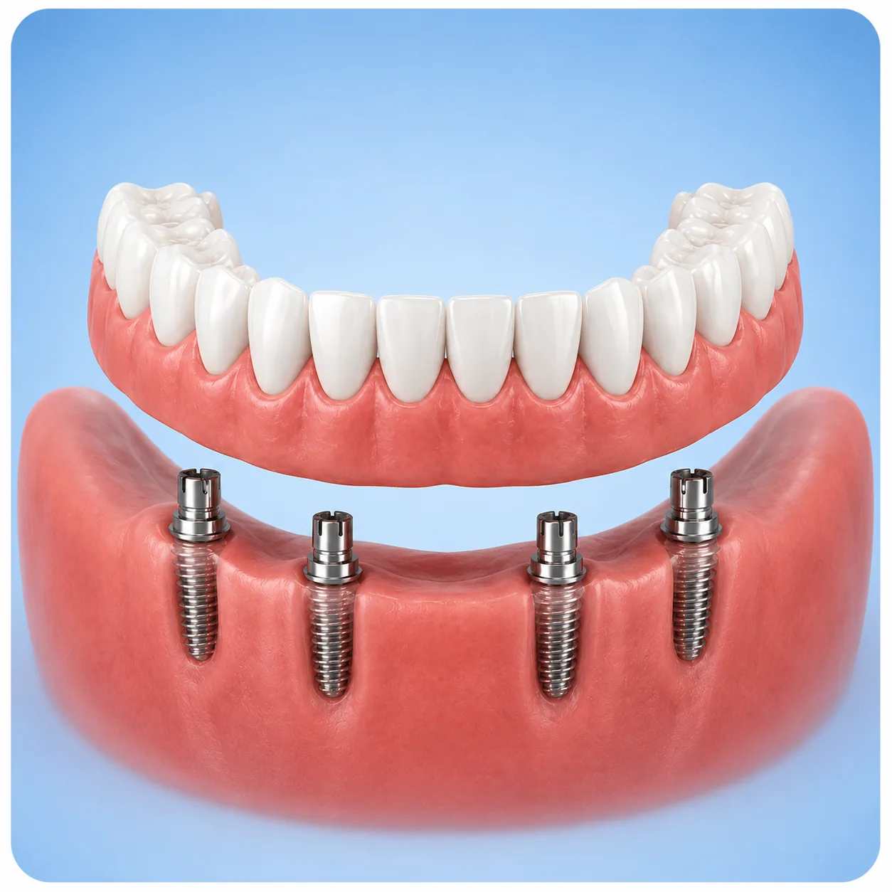 all-on-4-dental-implants 3D illustration of an All-on-4 lower denture supported by four dental implants