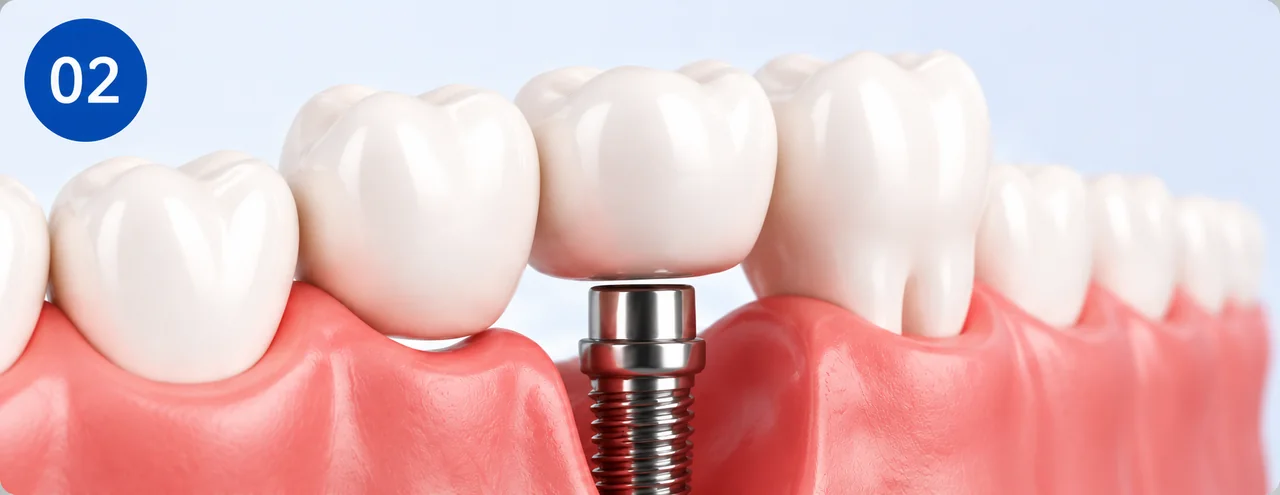 benefit-protection-neighbouring-teeth.webp Dental implant replacing a tooth without altering the neighbouring teeth