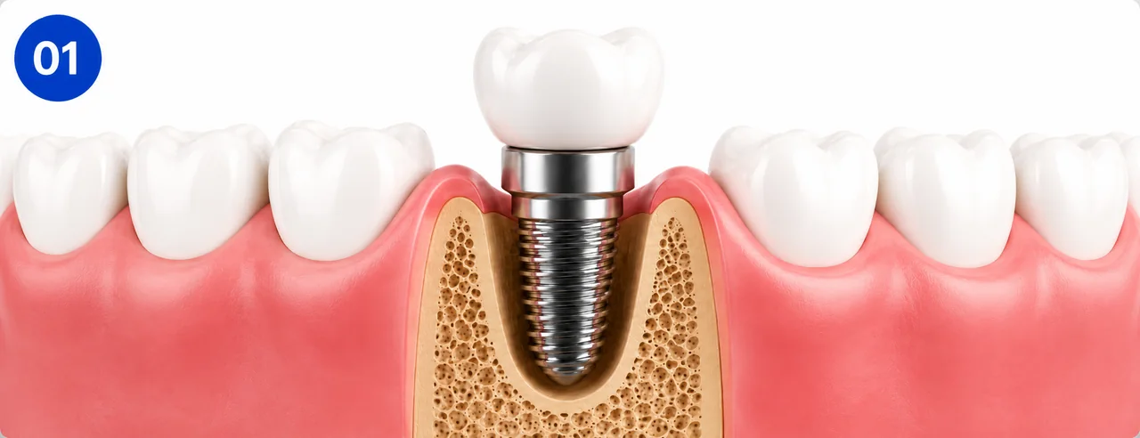 benefit-stable-tooth-replacement.webp : Dental implant providing a stable replacement tooth