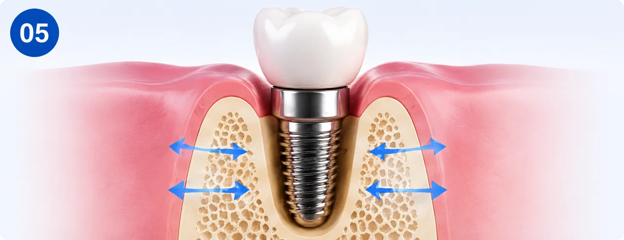 benefit-support-for-jawbone.webp Dental implant helping support the jawbone