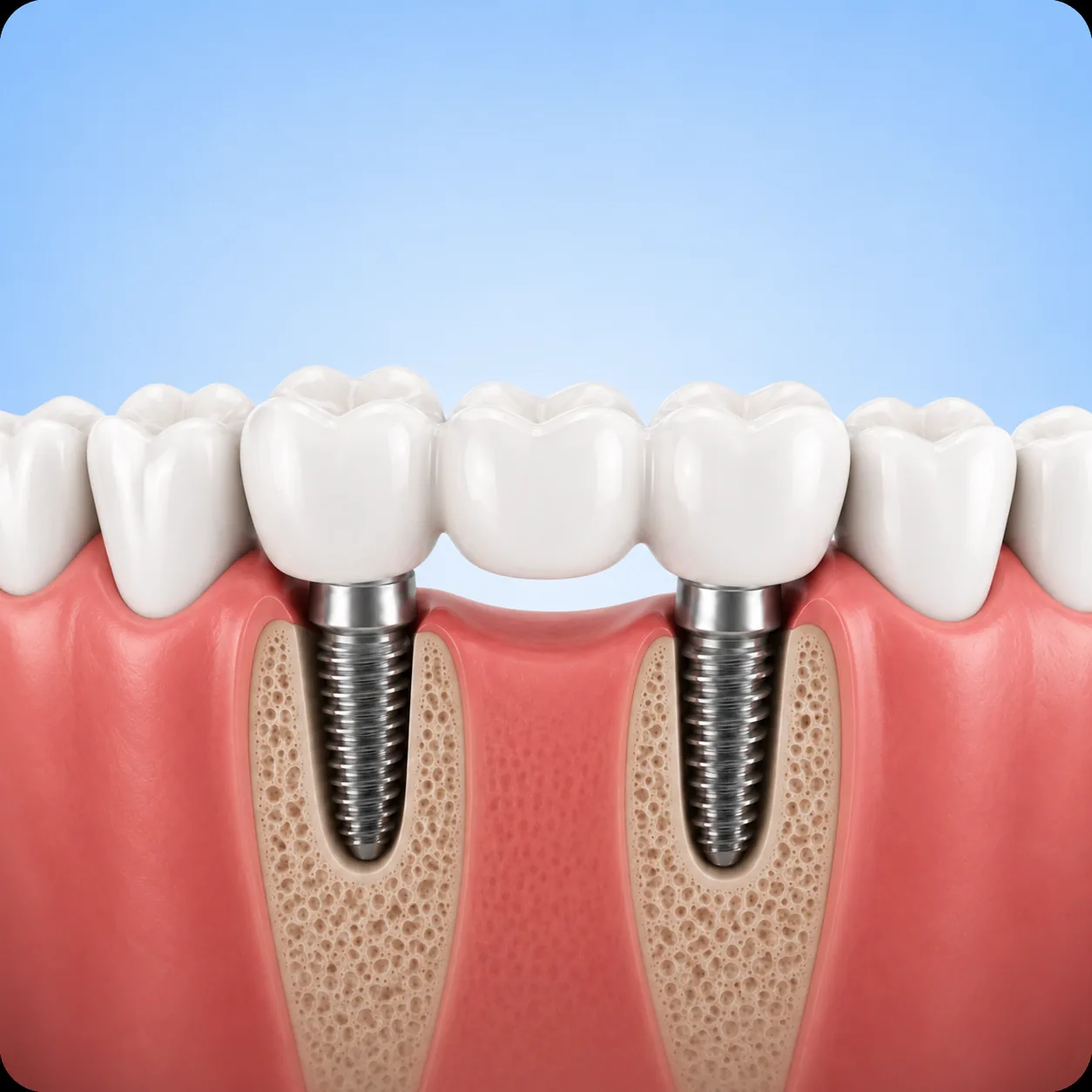 multiple-teeth-dental-implants 3D illustration of an implant-supported bridge replacing multiple missing teeth