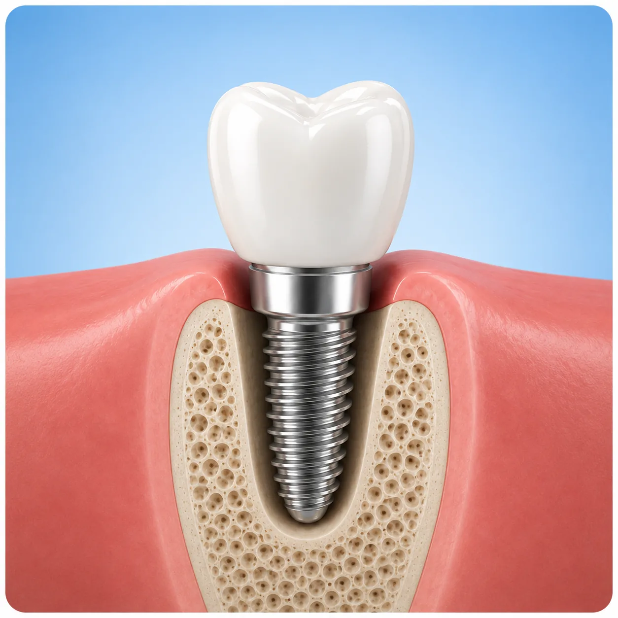 single-tooth-dental-implant 3D illustration of a single-tooth dental implant with a crown and titanium post