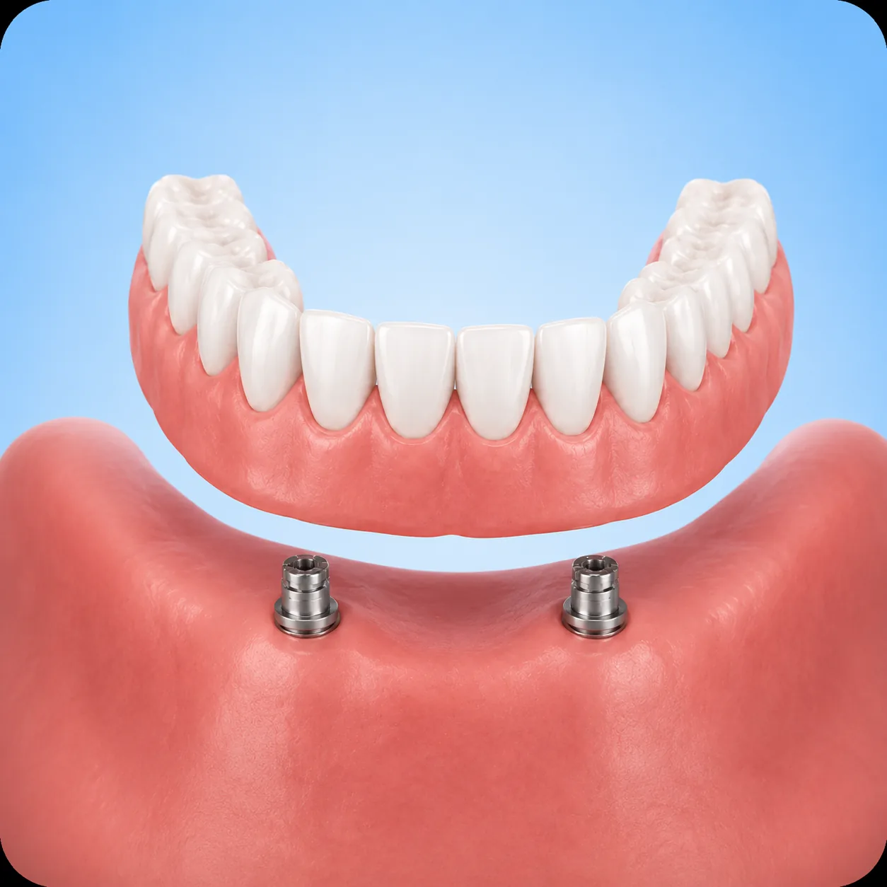 snap-in-implant-dentures 3D illustration of a lower snap-in denture supported by two dental implants