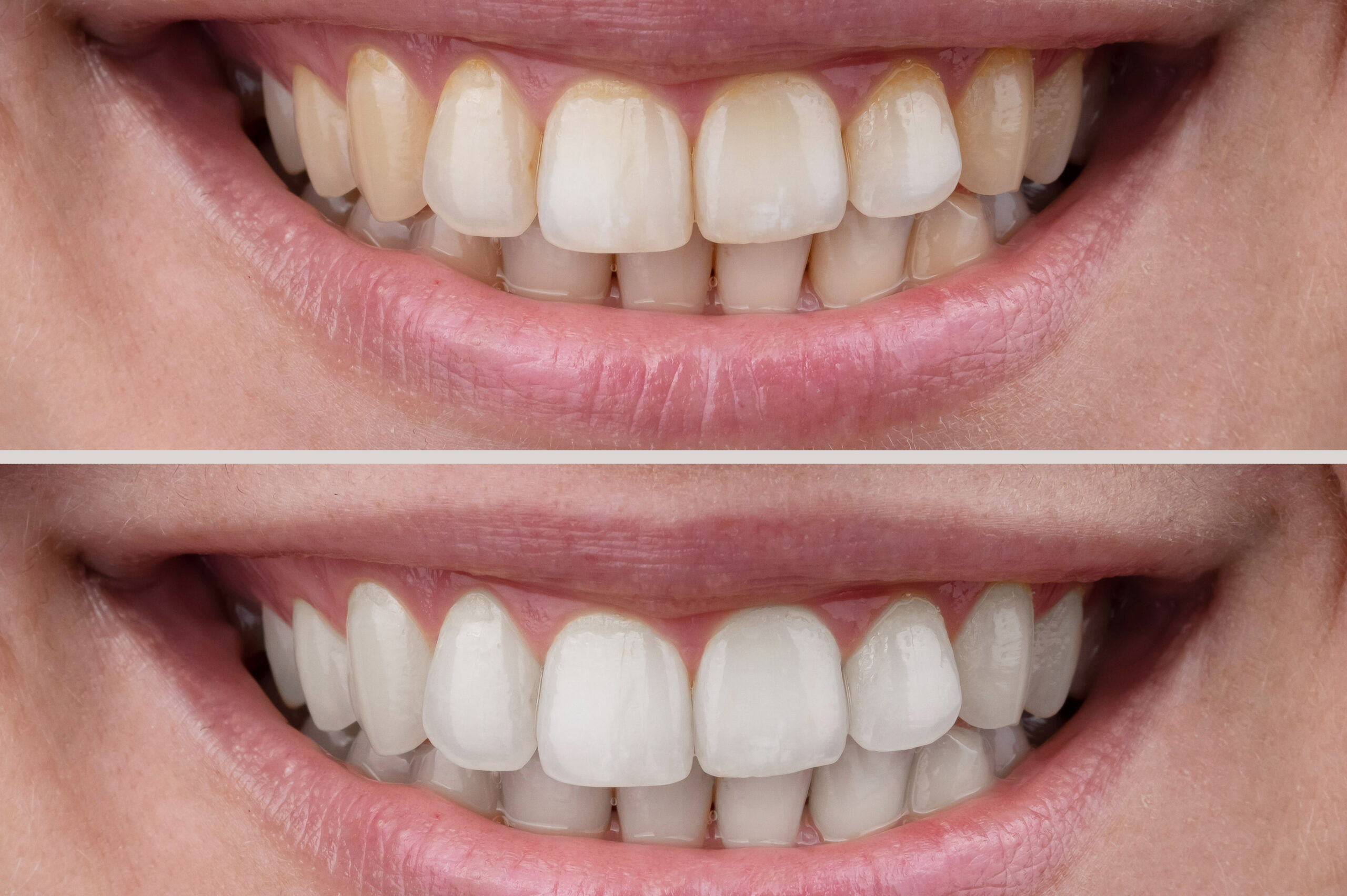 <br />
teeth whitening