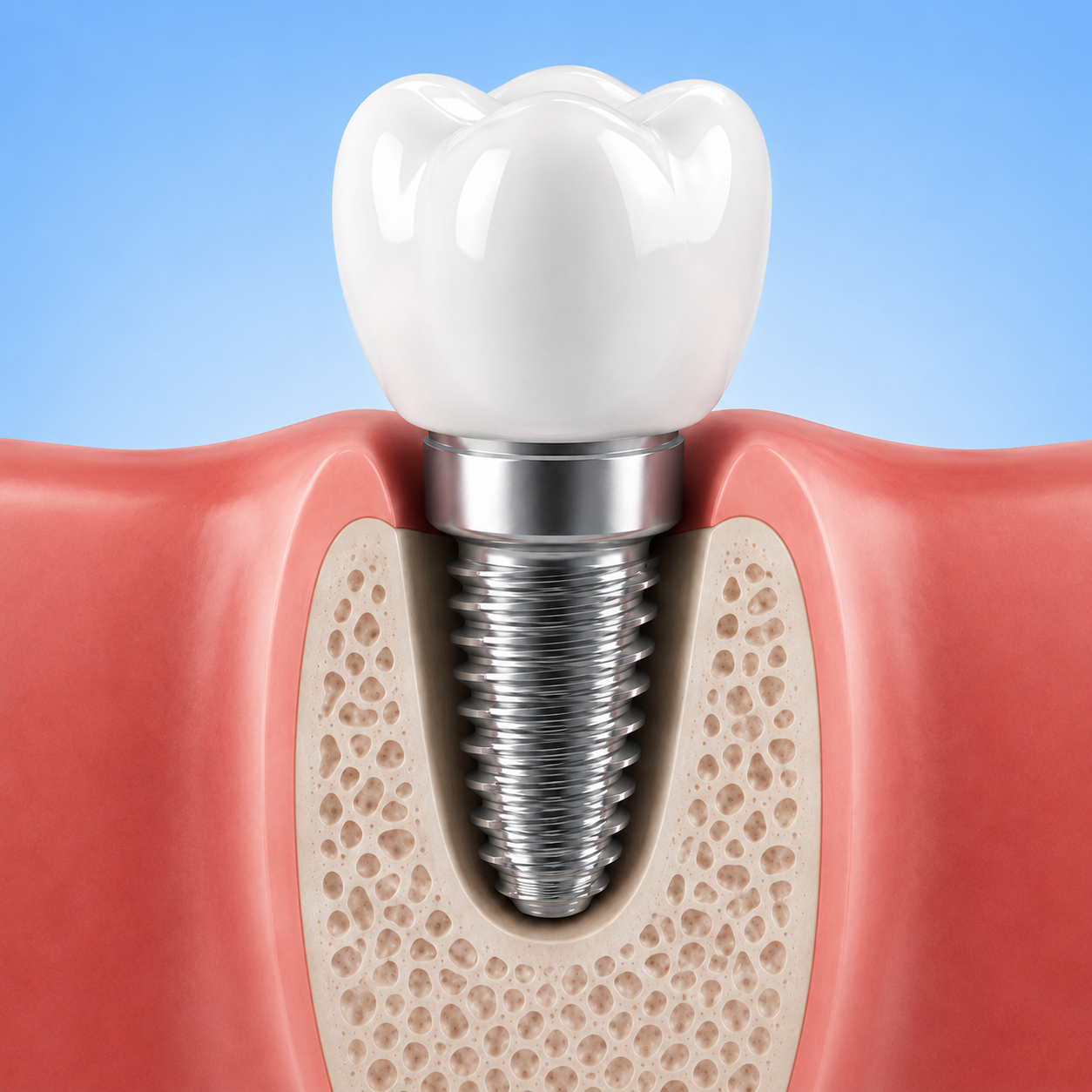 Single-tooth dental implant replacing a missing tooth