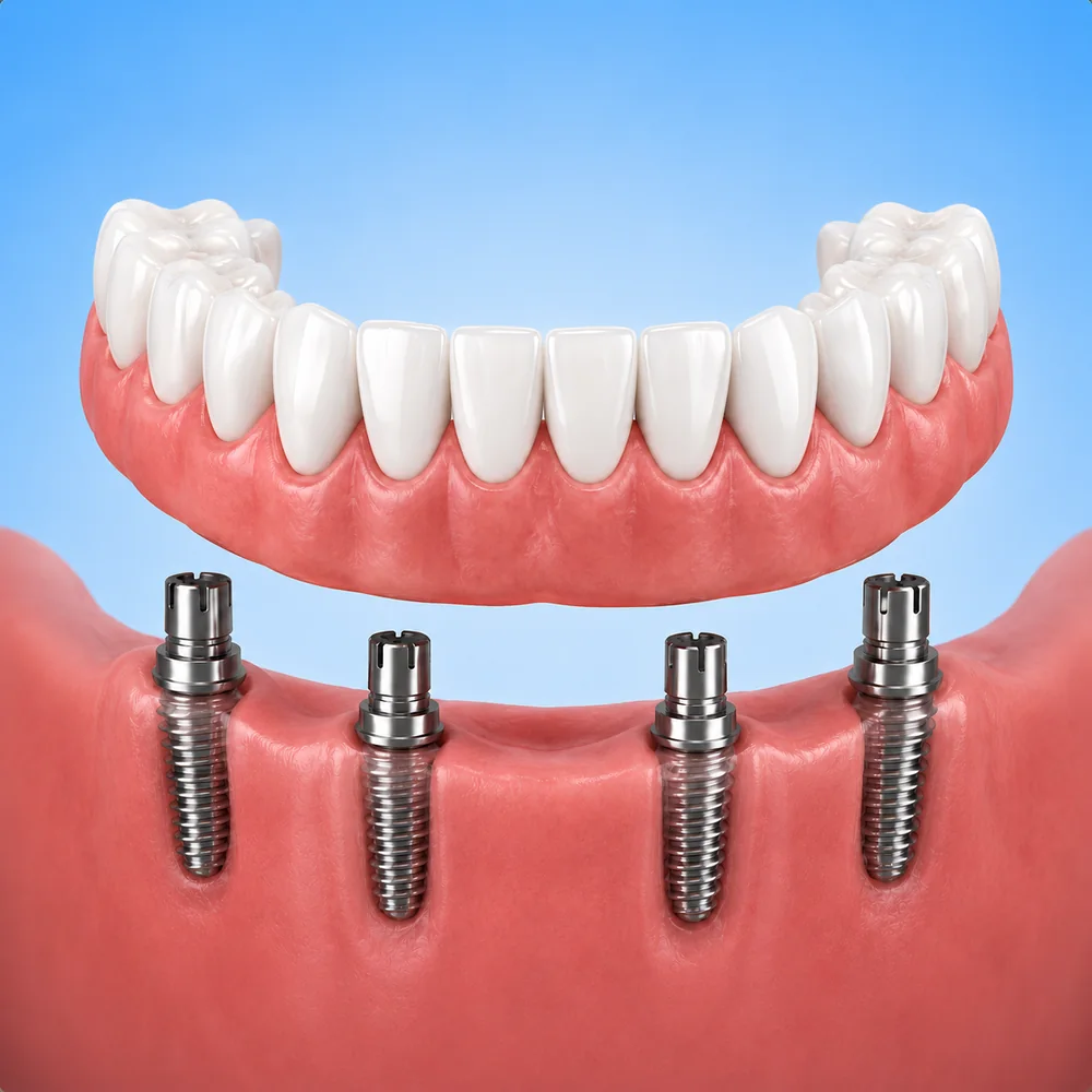 Single-tooth dental implant replacing a missing tooth