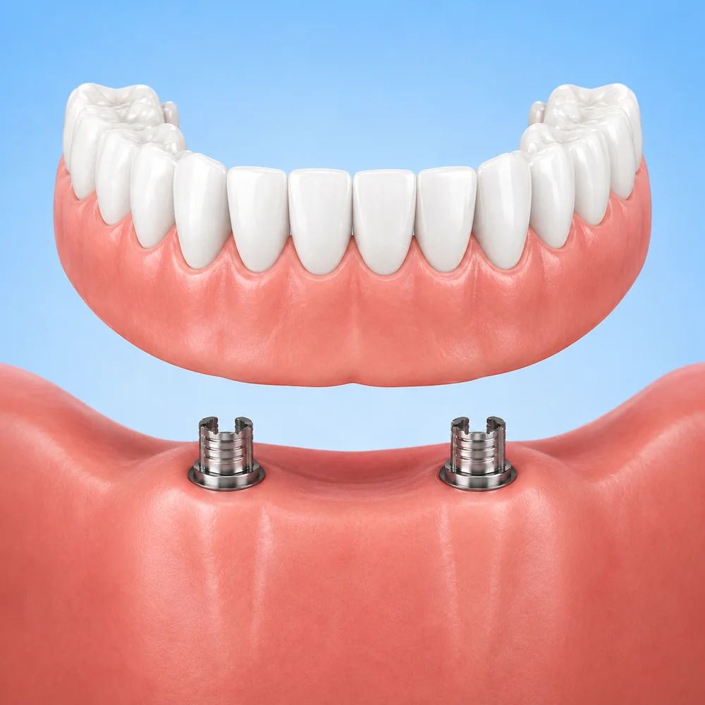 Single-tooth dental implant replacing a missing tooth