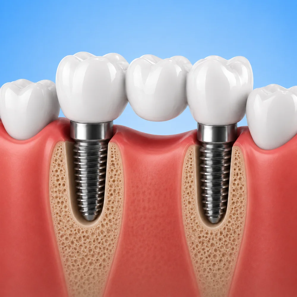 Single-tooth dental implant replacing a missing tooth