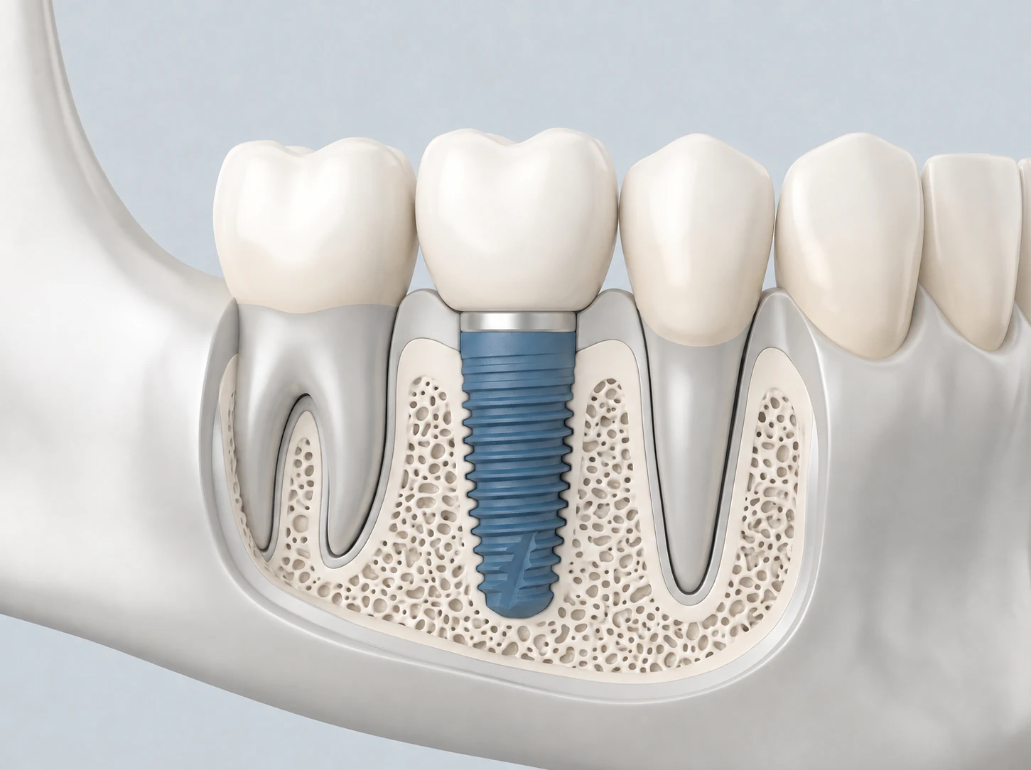 Illustration of a dental implant supporting a crown between natural teeth